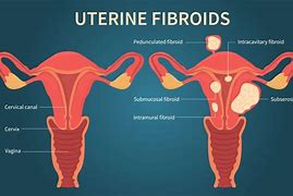 Image result for Uterine Fibroids in Uterus Nursing Diagnosis