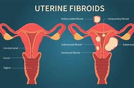 Image result for 1 Cm Fibroid in Uterus