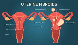 Image result for Posterior Intramural Uterine Fibroid