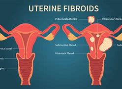 Image result for Hysterectomy Fibroid Tumors Uterine