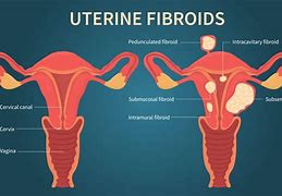 Image result for Ovarian Cysts and Fibroids