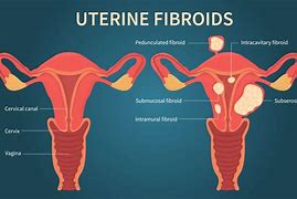 Image result for 10 Cm Fibroid Photos