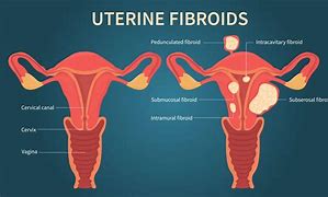 Image result for Uterine Fibroid Myomectomy