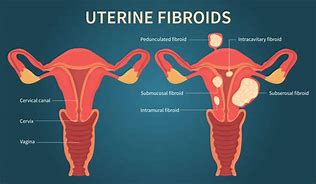 Image result for Uterine Fibroid Pressing On Bladder
