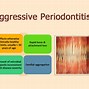 Image result for Aggressive Periodontitis