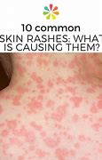 Image result for Rashes Types and Symptoms