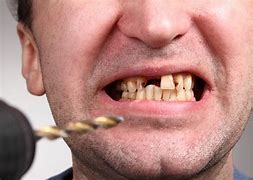 Image result for Very Bad Teeth