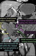 Image result for Closed Loop Obstruction Radiology