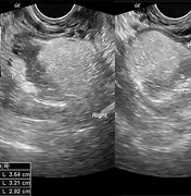 Image result for Dermoid Cyst Uterus