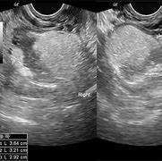 Image result for Ovarian Dermoid Radiology