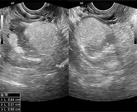 Image result for Dermoid Cyst On Ovary