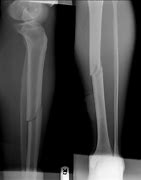 Image result for Motorcycle Accident Broken Arms and Legs
