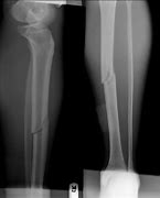 Image result for Broken Leg Hospital