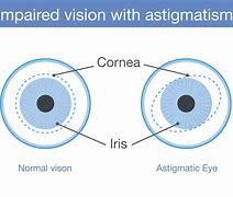 Image result for Astigmatism Eye Blood