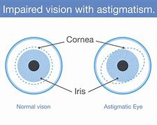 Image result for Astigmatism Text