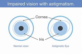 Image result for Astigmatism Drawing