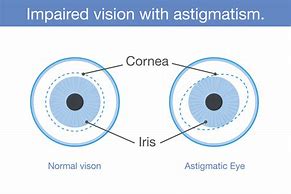 Image result for Astigmatic