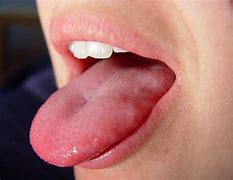 Image result for White Growth On Tongue