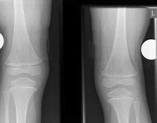 Image result for Nail-patella Syndrome