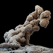 Image result for Pictures of Teratomas