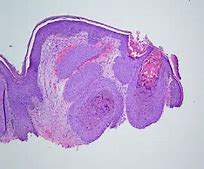 Image result for Molluscum Face