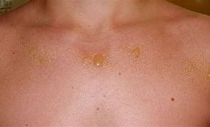Image result for Sun Poisoning Blisters