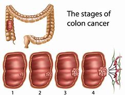 Image result for Images of Cancerous Colon Polyps