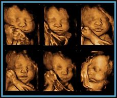 Image result for Week 30 Twins 3D Ultrasound
