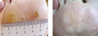 Image result for Wart Removal On Leg