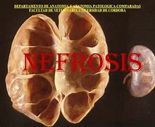 Image result for nefrosis