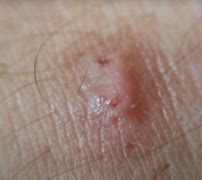 Image result for Common Wart On Elbow