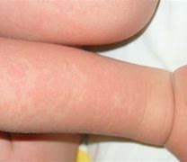 Image result for Fifrth Disease Rash