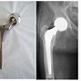Image result for Hip Pinning Surgery