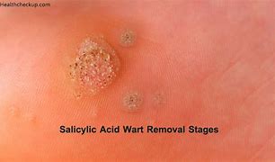 Image result for Common Wart Anatomy
