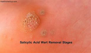 Image result for Skin Warts On Back