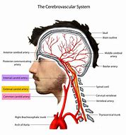 Image result for Carotid Artery Occlusion