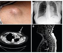 Image result for 9Mm Lesion