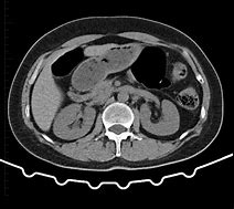 Image result for RT Kidney Mass