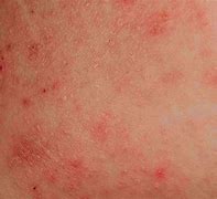 Image result for Itchy Skin Rash On Torso