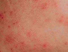 Image result for Skin Eruptions with Blisters