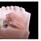 Image result for Magnet Dental Attachment