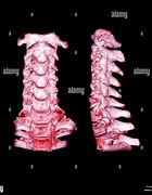 Image result for C2 Cervical Spine