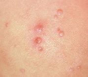 Image result for Molluscum Contagiosum in Adults