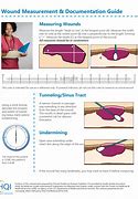 Image result for Foot Wound Measurements Undermining