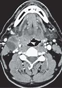 Image result for Metastatic Head and Neck Cancer
