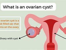 Image result for Ovarian Cyst Pictures