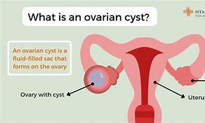 Image result for Right Part of Dermoid Cyst On Ovary