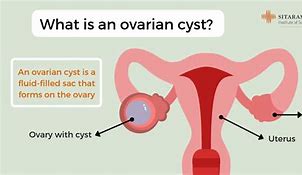Image result for ovary cysts removal