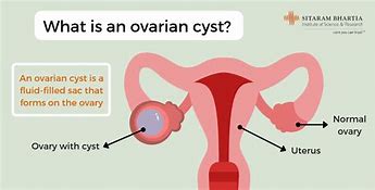 Image result for 5Cm Cyst On Ovary