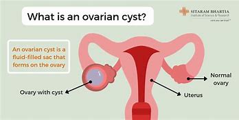 Image result for 8 Cm Cyst On Ovary